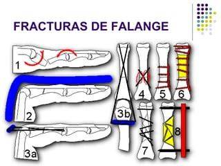 diagrama de patrones de fracturas de falange