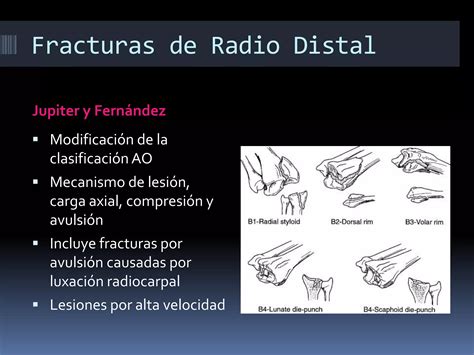 gráfico de resultados de tratamientos de fracturas de radio distal