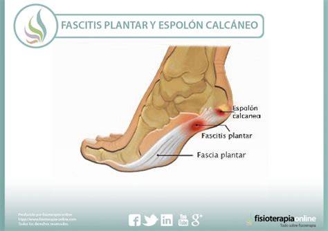 diagrama de espolón calcáneo y fascitis plantar
