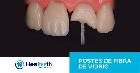 Comparativa de radiopacidades de postes de fibra de vidrio